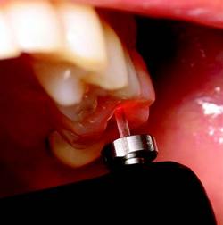 Non-invasive technology for accurate caries detection