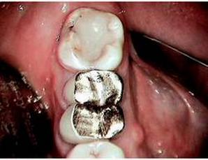 Tooth #30 has been endodontically treated, hemisected, and treated with individual crowns on each root. Note the lingual fistula on the mesial root.