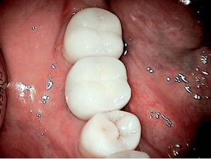Quadrant after extraction of #30, socket augmentation and implant placement.