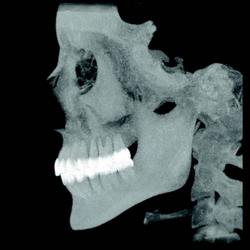 Maximum Intensity Projection