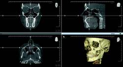 Pan, Ceph and 3-D in one scan