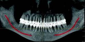 Panoramic With Nerve Mapping