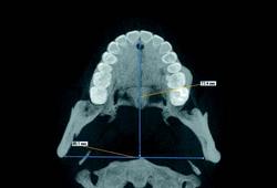 Dental Reformat Axial