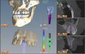 Implant, abutment, and restoration planning in one cohesive system