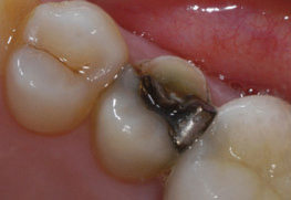 Figure 3: Dental phobic patient presentedwith fractured buccal cusp.