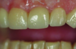 Eight restorations delivered. Substrate used was Empress CAD Multi A2 (Ivoclar Vivadent) with incisal and cervical stain.