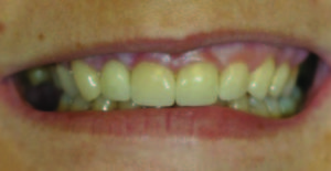 Secondary and tertiary anatomy added post milling very easily and predictably using the principles taught at E4D University.