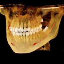 Identify the relationship between impacted tooth roots and nerve to increase accuracy of extractions