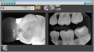 DEXIS CariVu technology