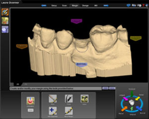 Figure 2. Scan of missing tooth and implant site number 20.