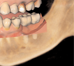 Figure 4. Restorative planning possibilities with CBCT data