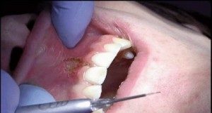 Buccal Frenom Immediate Post-Op