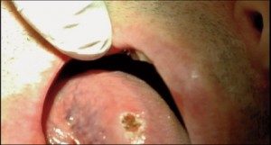 Fibroma right after removal shot