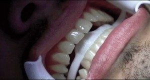 Laser Whitening Before