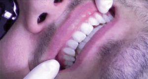 Laser Whitening After