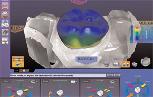 Case 1. Figure 3. This screen shot of the intuitive DentaLogic™ software shows the computer-generated model of the proposed restoration in the ICE mode (i.e., “I See Everything”), with the photographic rendering of the preparation and adjacent tooth structure. At any time during the design process, the E4D Dentist System operator can check the material thickness. Here, the blue color shows that there is at least the optimal thickness of 2 mm or more; around the margin the other colors indicate less porcelain near the finish line.