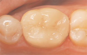 Case 1. Figure 4. Postoperative occlusal view of the same-day, in-office E4D restoration.