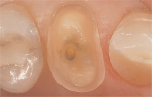 Case 2. Figure 2. View showing the preparation of the premolar for an E4D restoration and completion of a composite restoration on the canine.
