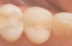 Case 2. Figure 5. Postoperative occlusal view of the final E4D restoration after final cementation.