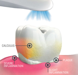 SoproCARE in Perio mode highlights different structures