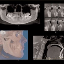 Figure 1: 1A is a reconstructed panoramic projection with a curved plane of section conforming to the jaw shape. 1B shows sectional images of the temporomandibular joints and a mid-sagittal plane section. 1C shows a threedimensional image that has been reconstructed from the CBCT volume. Surface image of the face has been accurately registered to the CBCT volume. The CBCT images were produced by iCAT, the surface imaging was produced by 3DMD Vultus and the registration and display was performed using Dolphin 3D.