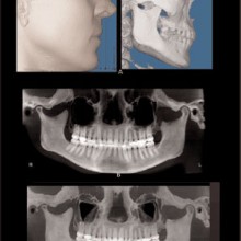 Figure 3: Shaded surface rendering (SSR) algorithms were used to visualize the skin and bone surfaces of the face (3A). 3B shows a standard reconstructed panoramic projection and 3C shows the same reconstruction using a minimum intensity projection (MIPS). The CBCT was acquired with the iCAT and rendered using Dolphin 3D.