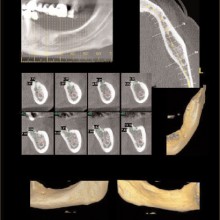 Figure 6: This series of images shows a very concise pre-surgical implant workup for the left half of the mandible. The mandible was scanned utilizing an iCAT CBCT 8-cm FOV and 0.2-mm cubic voxel size. The display was created with iCAT operating software and ISI's DVR program. The images have been cross-referenced with each other for precise localization of the anatomy. (Images courtesy of Amnon Leitner, Nahariya, Israel)