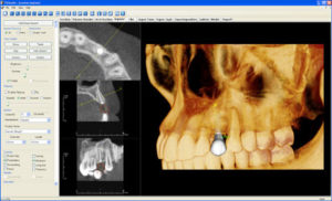 Figure 3. i-CAT® Precise™ scan in Tx STUDIO showing radiographic grayscale details as well as 3D rendering