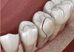 When it comes to cracked teeth and vertical tooth fractures, performing a thorough examination is essential.